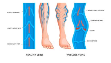 Understanding the Impact of Vein Bulges on Health
