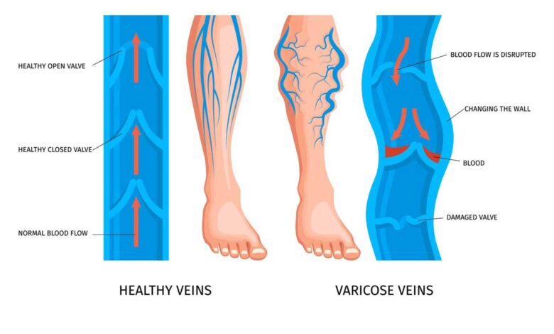 Understanding the Impact of Vein Bulges on Health